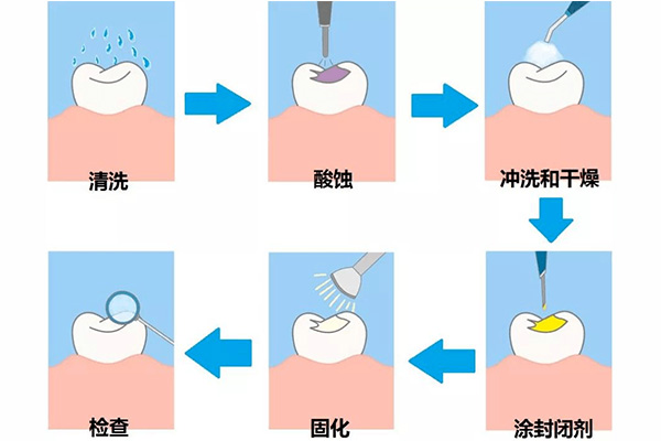 儿童牙齿做窝沟封闭有什么好处吗多少钱(儿童牙齿做窝沟封闭有什么好处吗多