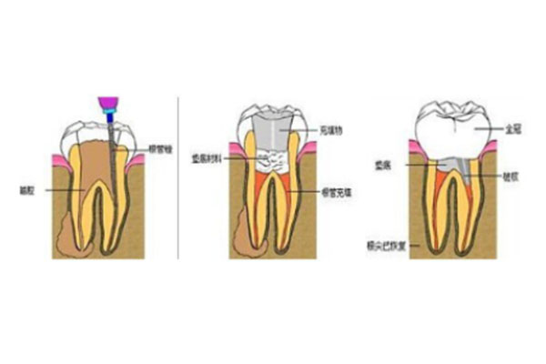 乳牙做完根管治疗还会长出新牙齿吗(乳牙做完根管治疗还会长出新牙齿吗图片