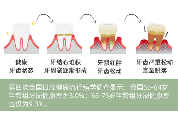 去洗牙说有牙周炎,建议牙周护理