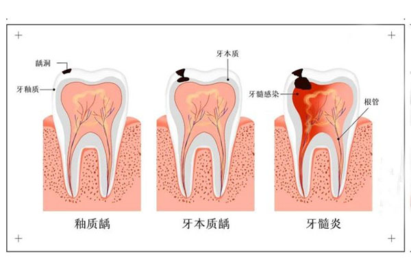 儿童牙髓炎吃什么药消炎止痛效果好(儿童牙髓炎吃什么药消炎止痛效果好一点