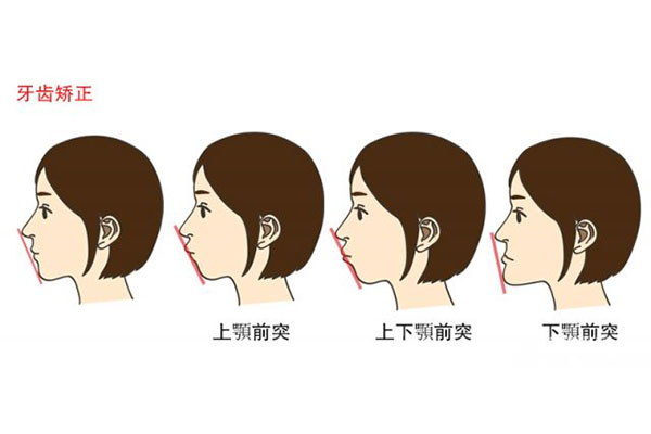 下颌牙列拥挤(下颌牙列拥挤图片)