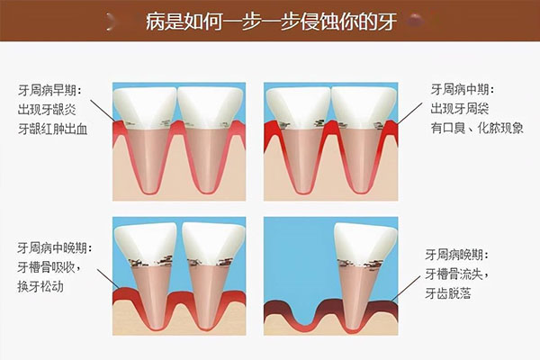 小孩牙周炎是什么原因导致的怎么治疗好(小孩牙周炎是什么原因导致的怎么治