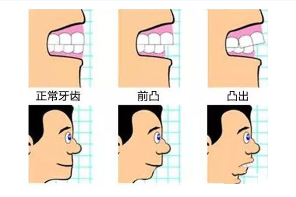 天包地嘴型深覆合(天包地深覆合能矫正吗)