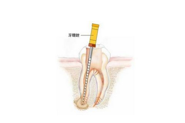 根管治疗杀死牙神经的药(根管治疗杀死牙神经的药掉了)