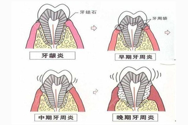 牙周炎怎么引起的或者说吃辣的就疼(牙周炎怎么引起的或者说吃辣的就疼痛)