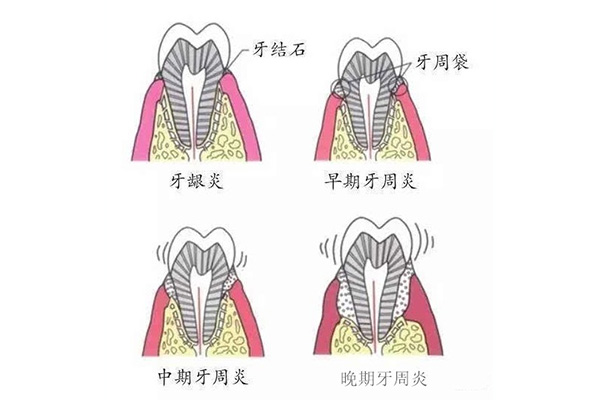 长期牙周炎怎么治疗最好(长期牙周炎怎么治疗最好的方法)