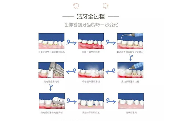 牙结石可以自己用洗牙器洗吗(牙结石可以自己用洗牙器洗吗)