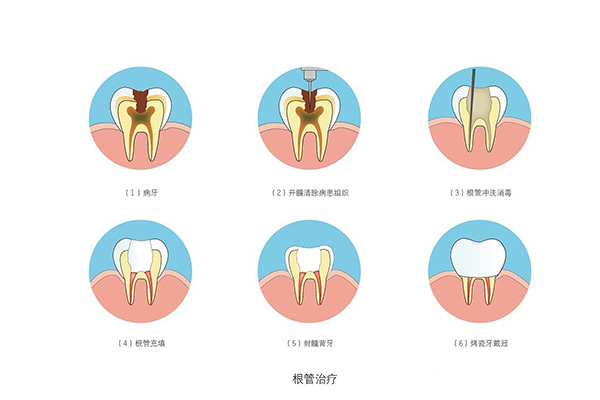 根管治疗用的消毒水(根管治疗用的消毒水叫什么)