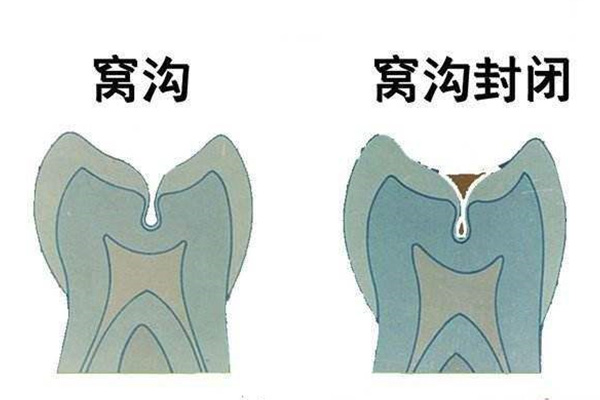 大人牙齿涂氟多少钱(大人牙齿涂氟多少钱一次图片)