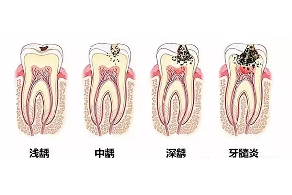 急性牙髓炎有多痛(急性牙髓炎有多痛苦)