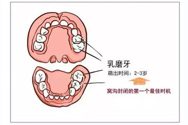 儿童牙涂氟和窝沟封闭(儿童牙涂氟和窝沟封闭哪个好)