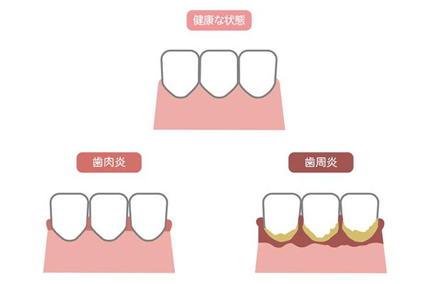 牙周炎的病因有哪些症状呢吃什么药(牙周炎的病因有哪些症状呢吃什么药最好