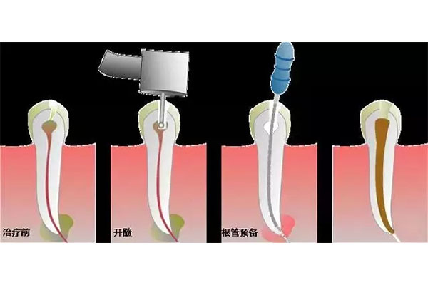 牙齿根管治疗后需要戴牙套吗多少钱一颗(牙齿根管治疗后要带牙套吗 多少钱