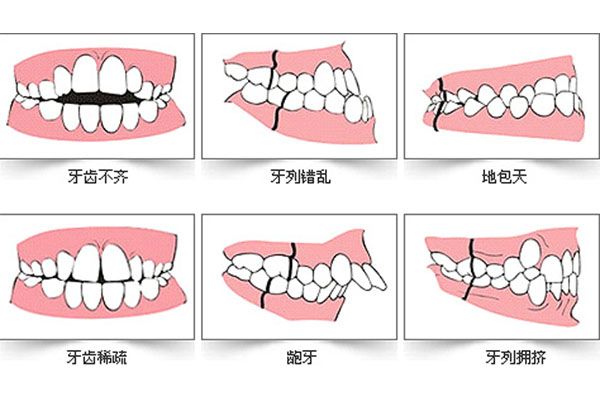 牙齿中线不齐矫正要多久(牙齿中线不