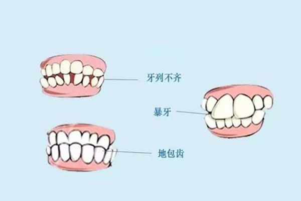 儿童天包地要怎么矫正多少钱(儿童天