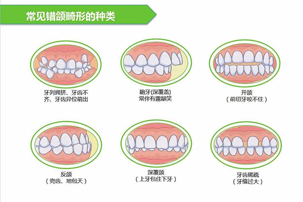 牙列不齐的定义是什么(牙列不齐的定