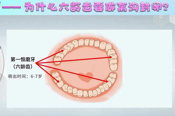 六龄齿牙是哪一颗牙齿换的(六龄齿牙是哪一颗牙齿换的图片)