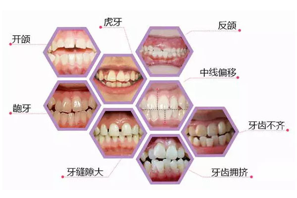 下排两颗牙齿不齐 需要拔牙矫正吗(下排两颗牙齿不齐 需要拔牙