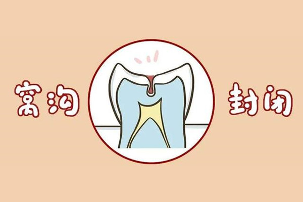 什么是六龄牙齿窝沟封闭手术