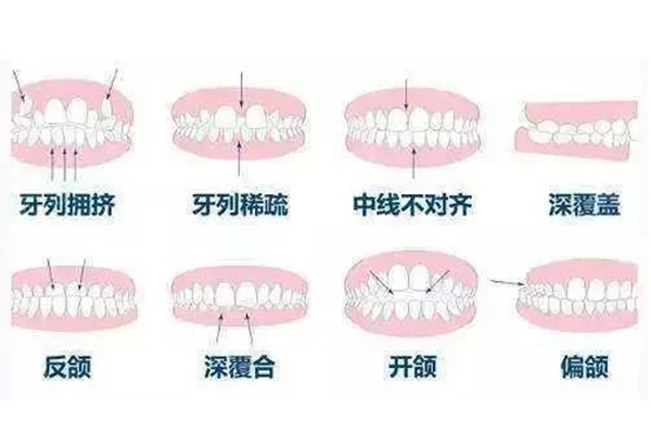 骨性龅牙和正常人的对比(骨性龅牙的坏处)