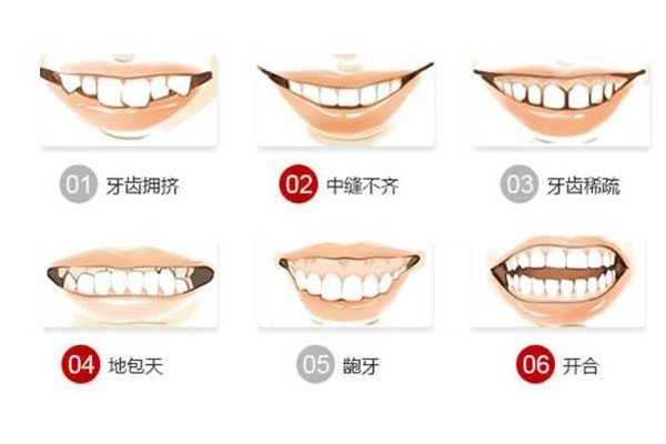 儿童牙齿不齐怎么矫正要拔牙吗多少钱呀(儿童牙齿不齐怎么矫正