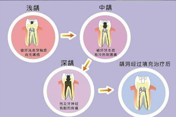 牙齿有虫牙怎么办中间变黑用什么牙膏好(虫牙黑黑的用什么洗)