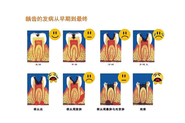 怎么知道牙齿是不是蛀牙(怎么判断牙齿是不是蛀牙)