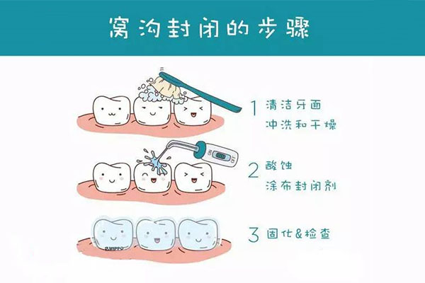 牙齿窝沟封闭术是啥意思啊(牙齿窝沟封闭术是啥意思啊多少钱)