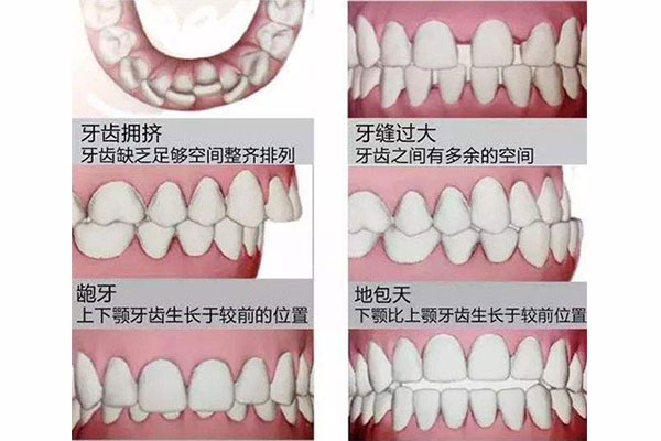 反颌牙齿(反颌牙齿图片)快速观看