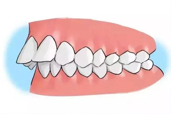 牙齿地包天16岁还能矫正吗(牙齿地包