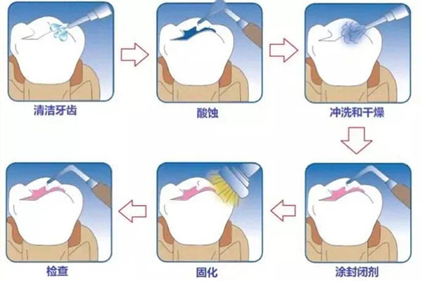 为什么医生不建议做窝沟封闭