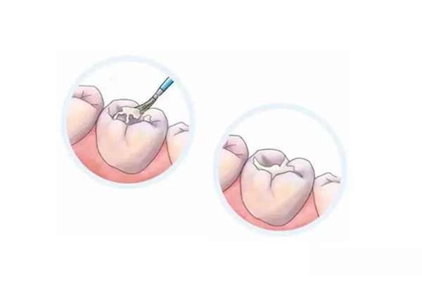 窝沟封闭有什么副作用(窝沟封闭有什么副作用和危害)