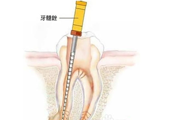 十岁六龄牙做根管治疗