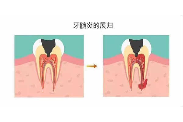 牙髓炎和牙根尖周炎哪个严重一些呢(牙髓炎和牙根尖周炎哪个严重一些呢怎么