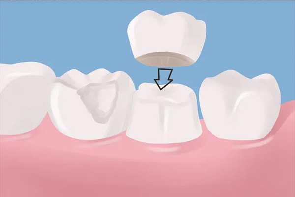 全瓷牙使用多久更换(全瓷牙使用多久更换一次好)