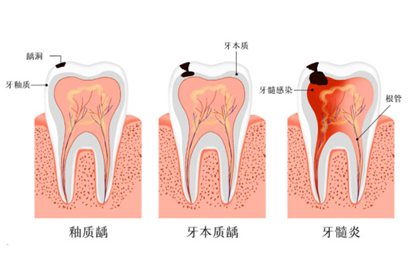 牙髓炎治疗多少次才能治好(牙髓炎治疗多少次才能治好呀)