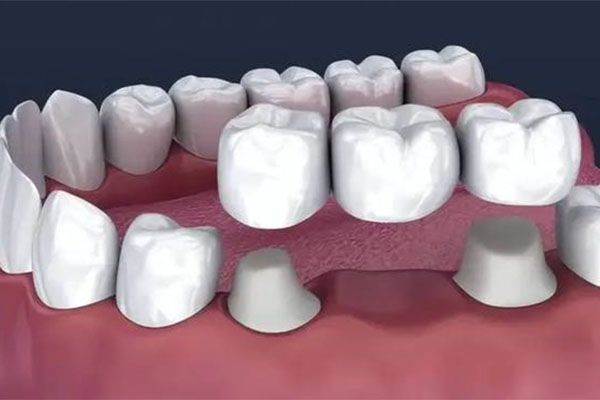 铸瓷牙和全瓷牙哪个牢固(铸瓷牙和全瓷牙哪个牢固度高)