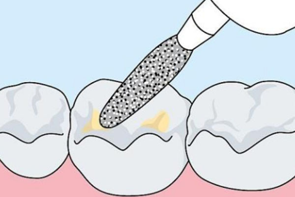 窝沟封闭剂脱落后牙齿更容易坏吗(窝沟封闭剂脱落后牙齿更容易坏吗)