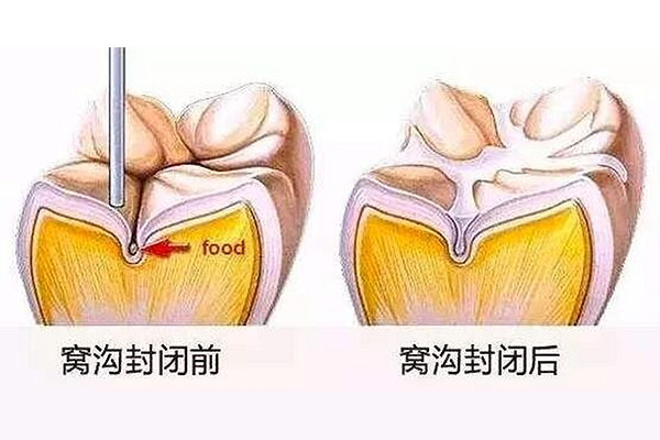 窝沟封闭的材料有味道吗有毒吗(窝沟封闭的材料有味道吗有毒吗)