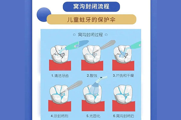 什么是牙齿的窝沟封闭