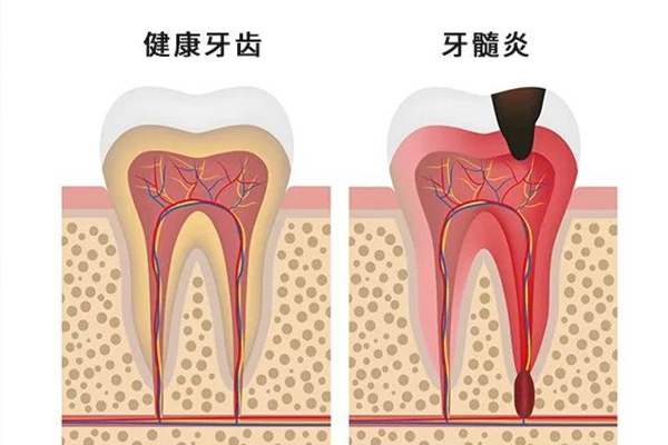 牙髓炎不同阶段的治疗方法有哪些(牙髓炎不同阶段的治疗方法有哪些区别)