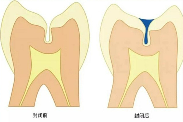 窝沟封闭年龄段是多大的(窝沟封闭年龄段是多大的孩子)