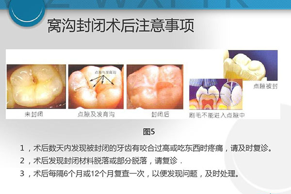 窝沟封闭需要的材料是什么东西(窝沟封闭需要的材料是什么东西图片)