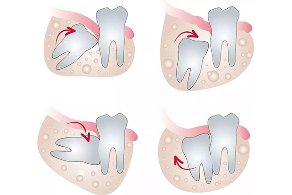 低位阻生智齿什么意思(低位阻生智齿会一直生长么)