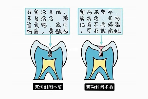 小孩做窝沟封闭是哪几颗牙齿做的(小孩做窝沟封闭是哪几颗牙齿做的好)