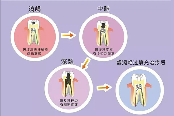 蛀牙已经烂空了怎么办非常疼痛吃什么药好得快(蛀牙烂掉空了疼死了)