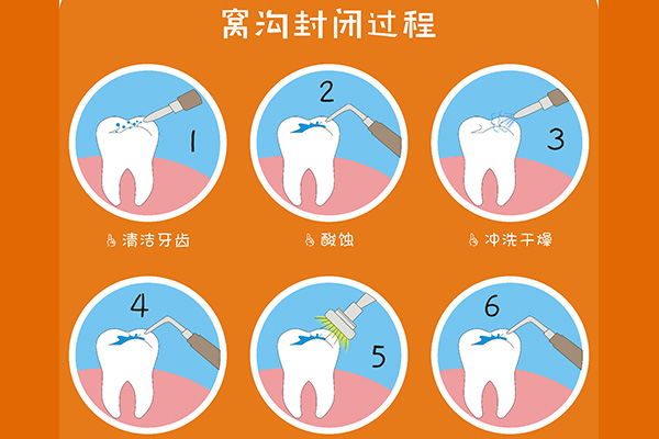 孩子什么时候做窝沟封闭好不好呢(孩子什么时候做窝沟封闭好不好呢图片)