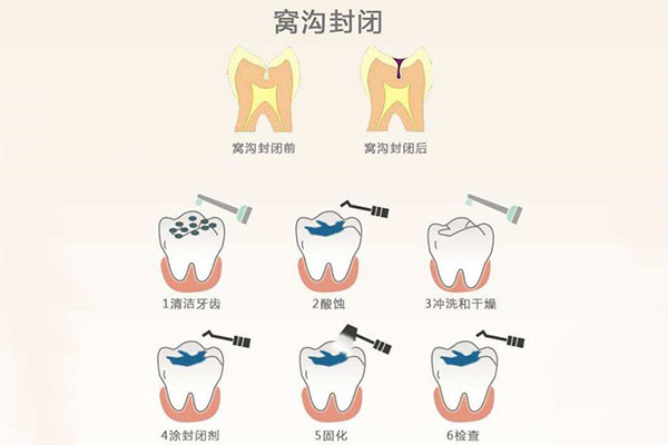 深圳小学生窝沟封闭(深圳小学生窝沟封闭医疗机构和政府结算)