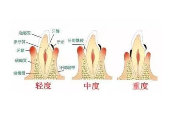 什么是慢性龋