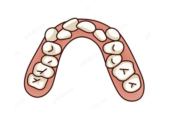 牙列不齐是什么意思呀(牙列不齐是什么意思呀)全程干货知识